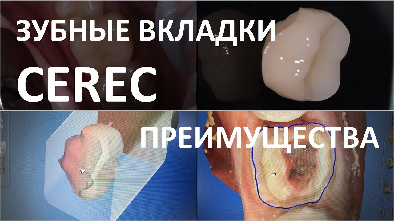 Преимущества зубных вкладок Cerec. Клиника Cerecon, Москва. На вопросы отвечает Сергей Самсаков