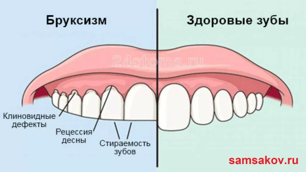 Бруксизм