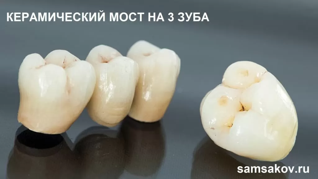 Зубные коронки на жевательные зубы