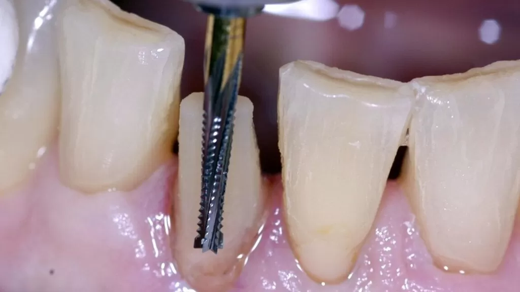 Как сильно проводится обточка зубов при установке виниров