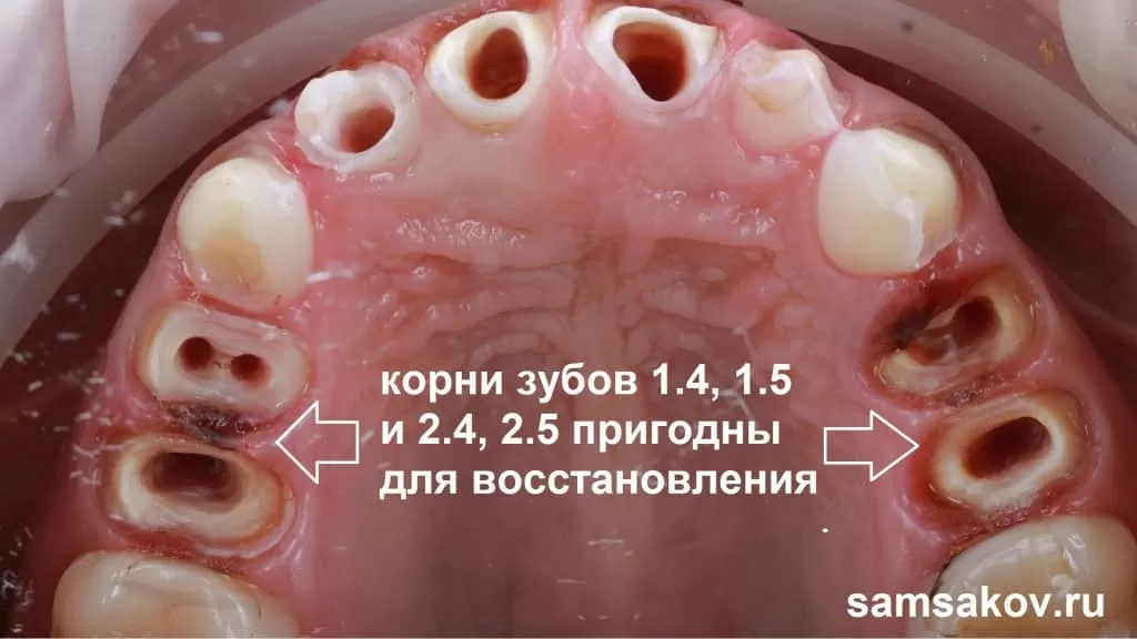 От зуба остался только корень: восстановление без имплантации