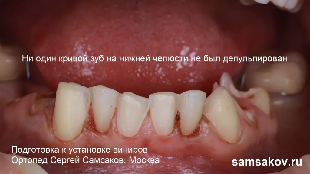 Ни один зуб не был депульпирован при установке виниров на нижнюю челсть