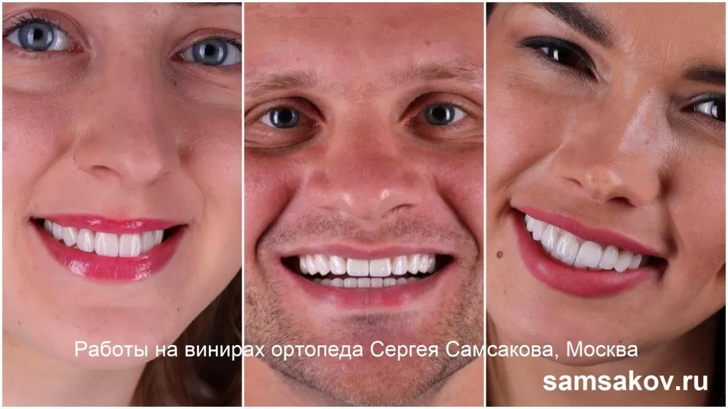 Широкие открытые улыбки пациентов с винирами