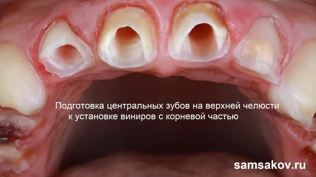 Обточка депульпированных зубов на верхней челюсти к установке виниров с корневой частью