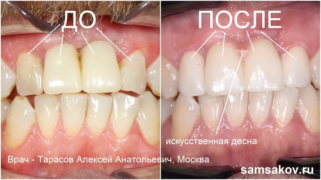 Протезы передних зубов на фото смотрятся очень эстетично, как на модели, так и непосредственно в зубном ряду