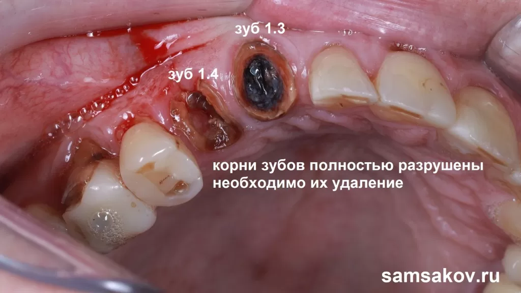 Оба корня зуба поражены кариесом. Плюс на корне зуба 1.3 большая киста