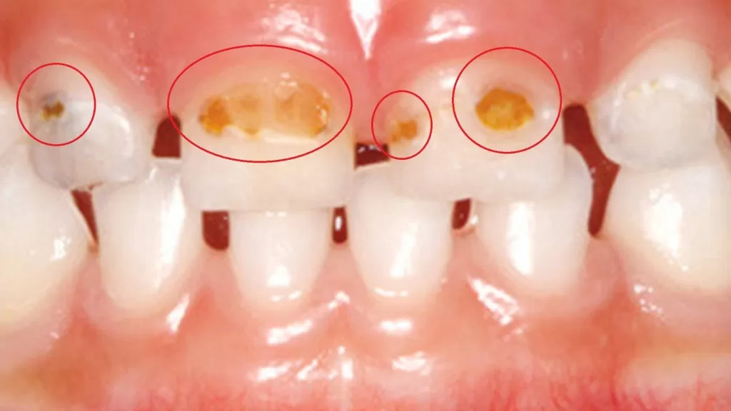Пришеечный кариес — это тип кариеса, который развивается у самого основания зуба, там где зуб встречается с десной, в области, которую мы называем "шейкой" зуба