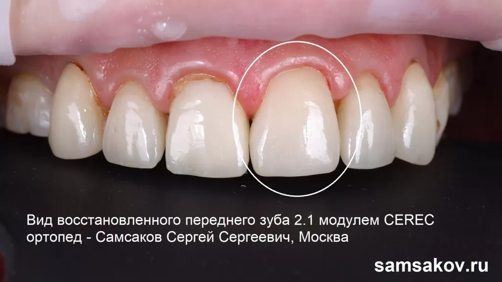 Реставрация переднего верхнего зуба модулем CEREC