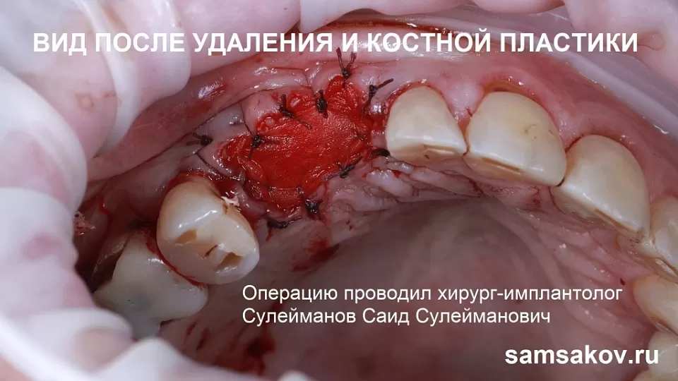 Пациент потерял зуб, а его можно было сохранить. Пример лечения с фото. Работа хирурга-имплантолога Сулейманова Саида Сулеймановича