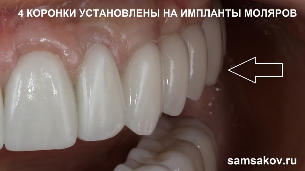 Коронки на имплант – лучшая замена утраченным зубам