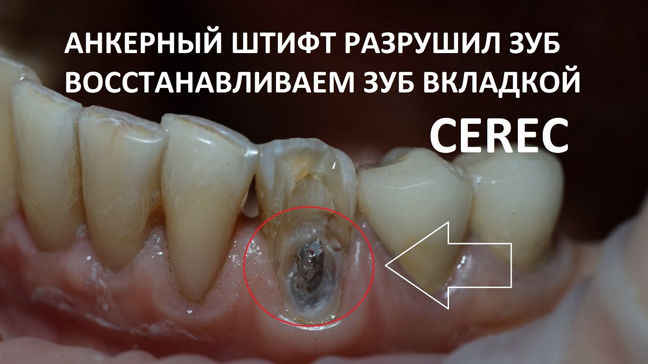 Восстановление зуба на анкерном штифте