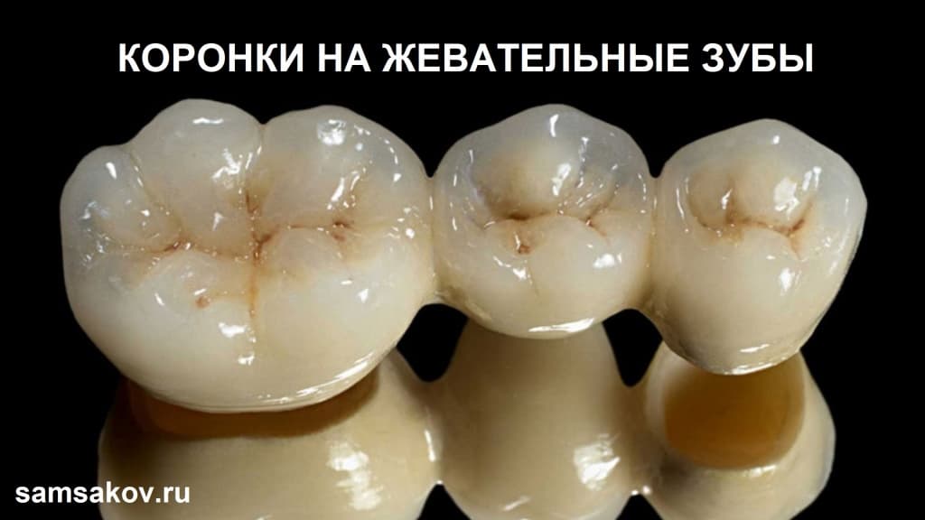 Какие коронки лучше ставить на жевательные зубы?