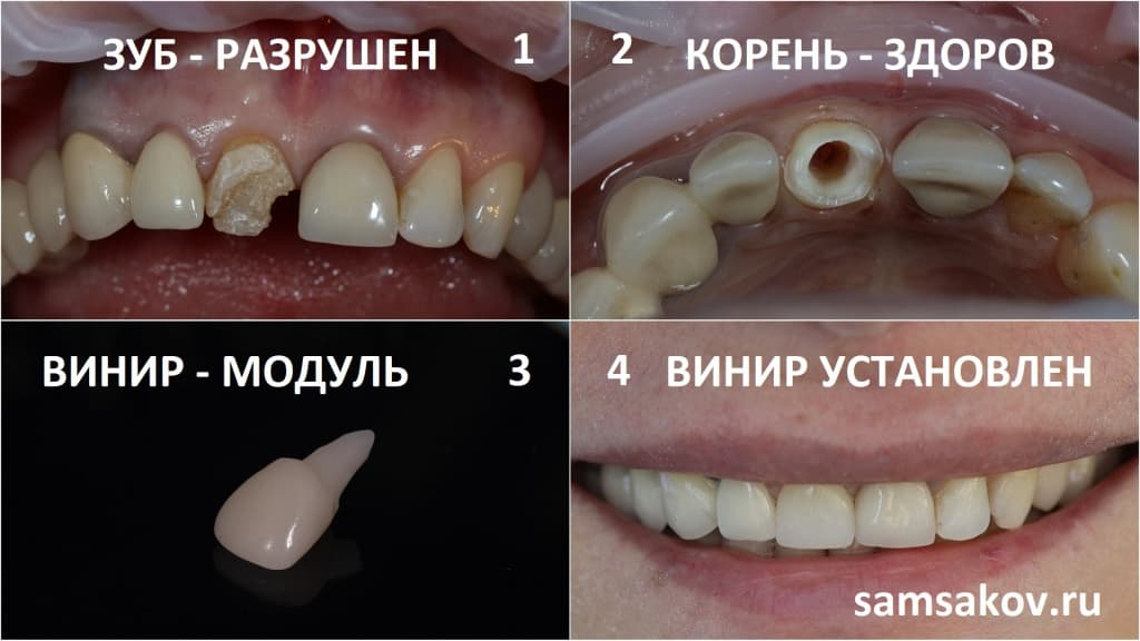 Для установки винира совершенно не обязательно иметь здоровый зуб. Работа ортопеда Сергея Самсакова, клиника Cerecon, Москва