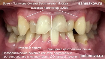 Подготовка зубов к установке импланта, коронок и виниров с помощью брекетов Damon Q