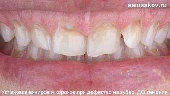 Пример лечения клиновидного дефекта и пришеечного кариеса на передних зубах винирами