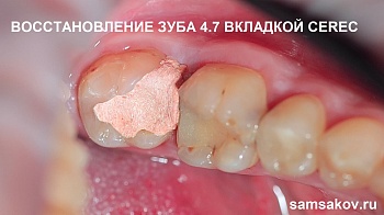 Восстановление зуба вкладкой CEREC