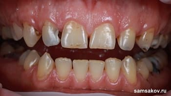 Как виниры успешно скрыли последствия глубокого кариеса на зубах
