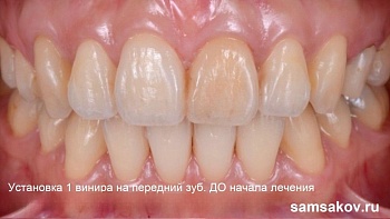 Винир на 1 передний зуб как пример экономии в стоимости и красивой эстетики лечения