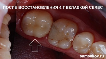 Восстановление зуба вкладкой CEREC