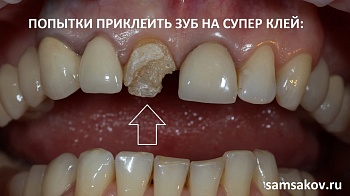 Восстановление испорченного супер клеем зуба