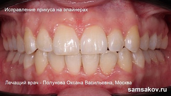 Капы для выравнивания зубов гораздо лучше брекетов, если у пациента повернутые зубы