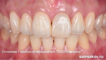Винир на 1 передний зуб как пример экономии в стоимости и красивой эстетики лечения