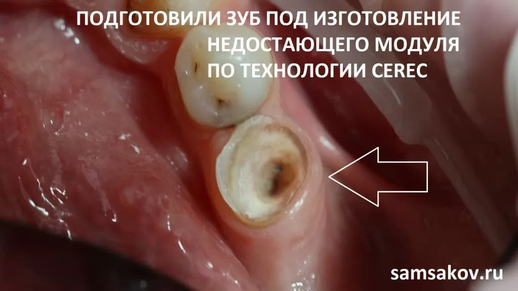 Ампутация корня зуба