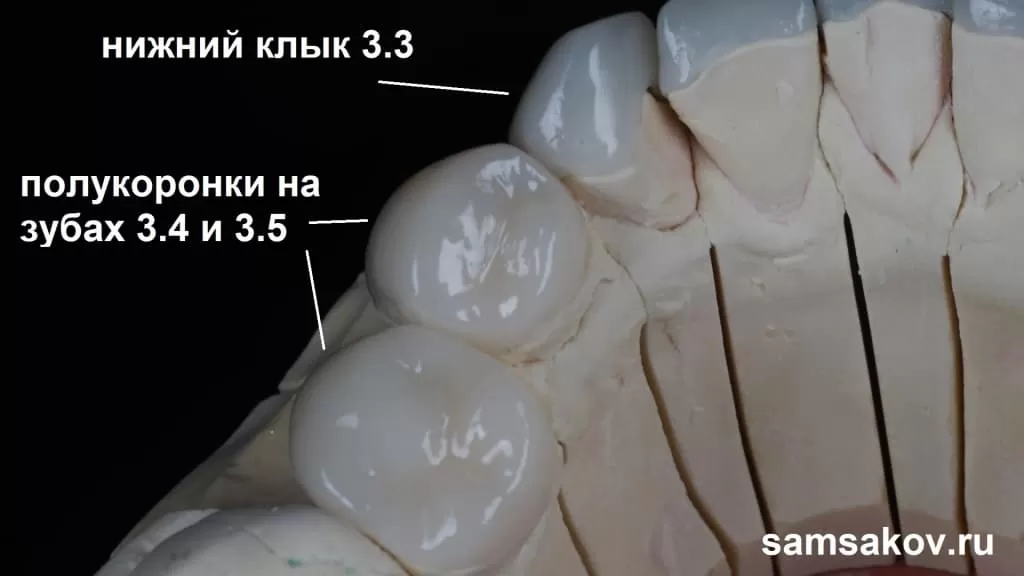 Керамическая коронка на зуб: особенности, преимущества, установка