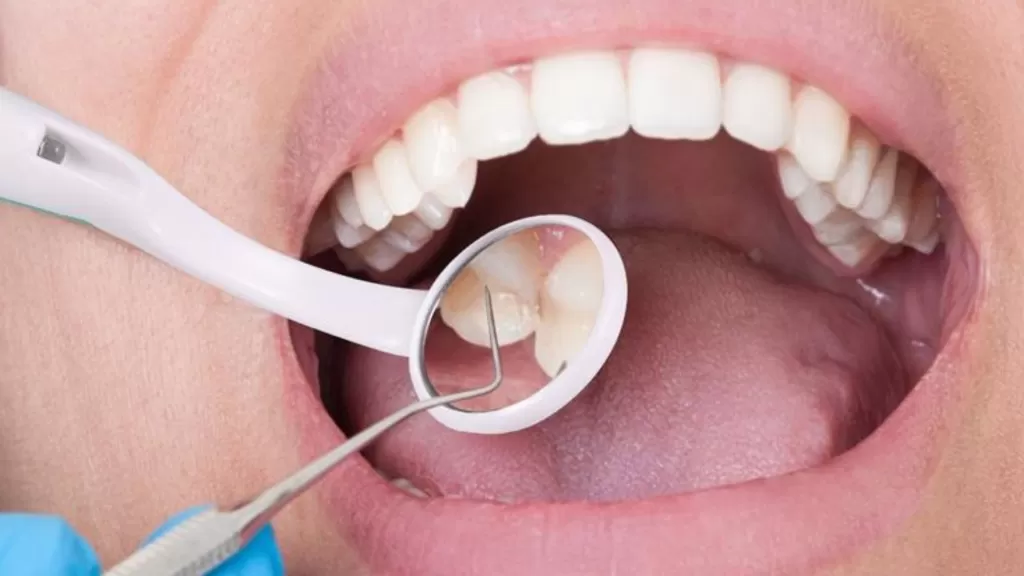 Зонд стоматологический