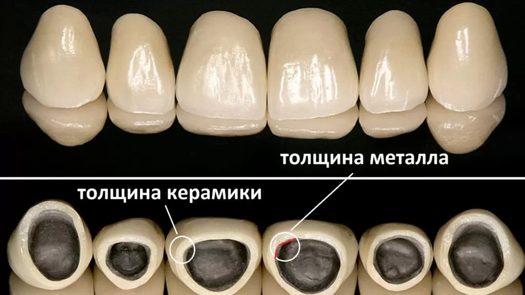 Комбинированная коронка на зуб и ее конкуренты