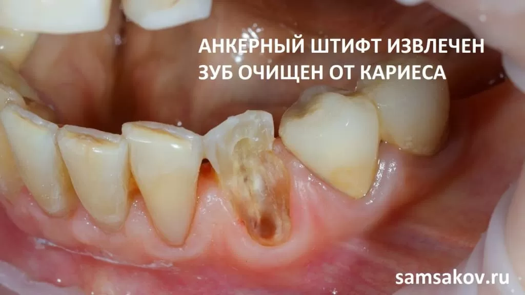 Зубные коронки: портят ли они зубы и другие мифы