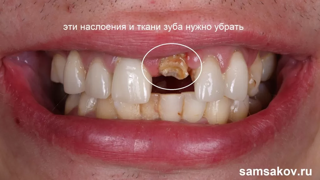 Разрушение зуба