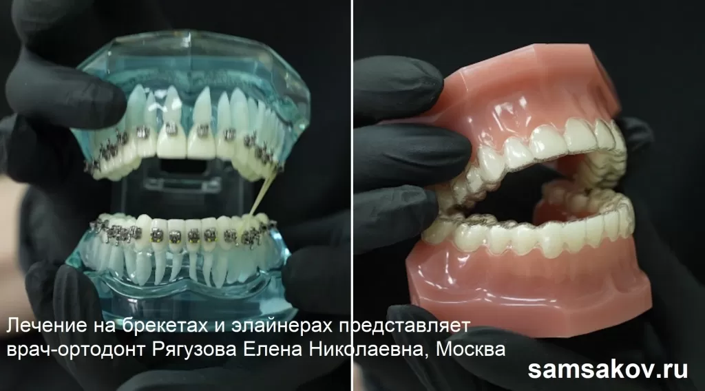 Возможно ли выравнивание зубов без брекетов?
