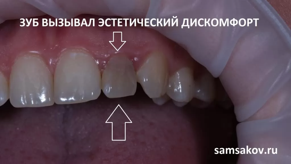 По какой причине после лечения зуб может потемнеть?