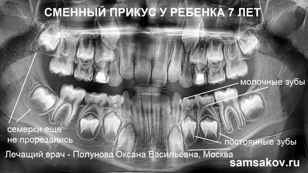 Зачаток зуба