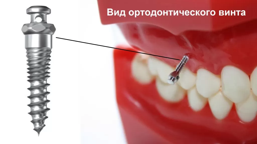 Винт ортодонтический