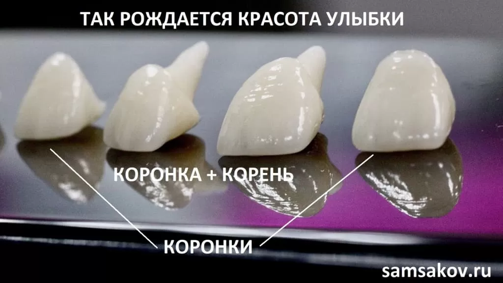 Зубные коронки: популярные виды, какие лучше поставить