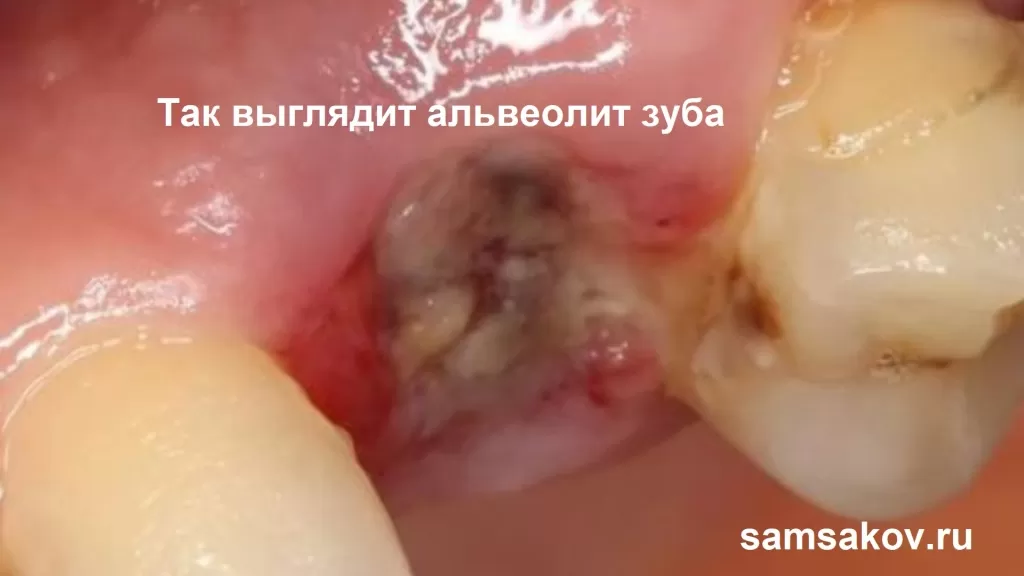 Альвеолит зуба