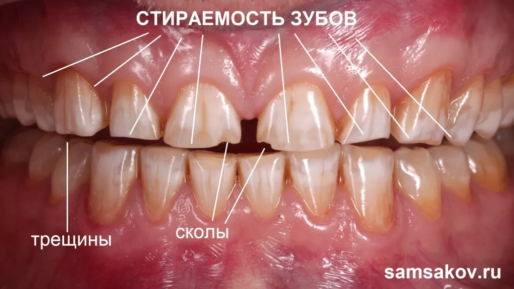 Стираемость зубов