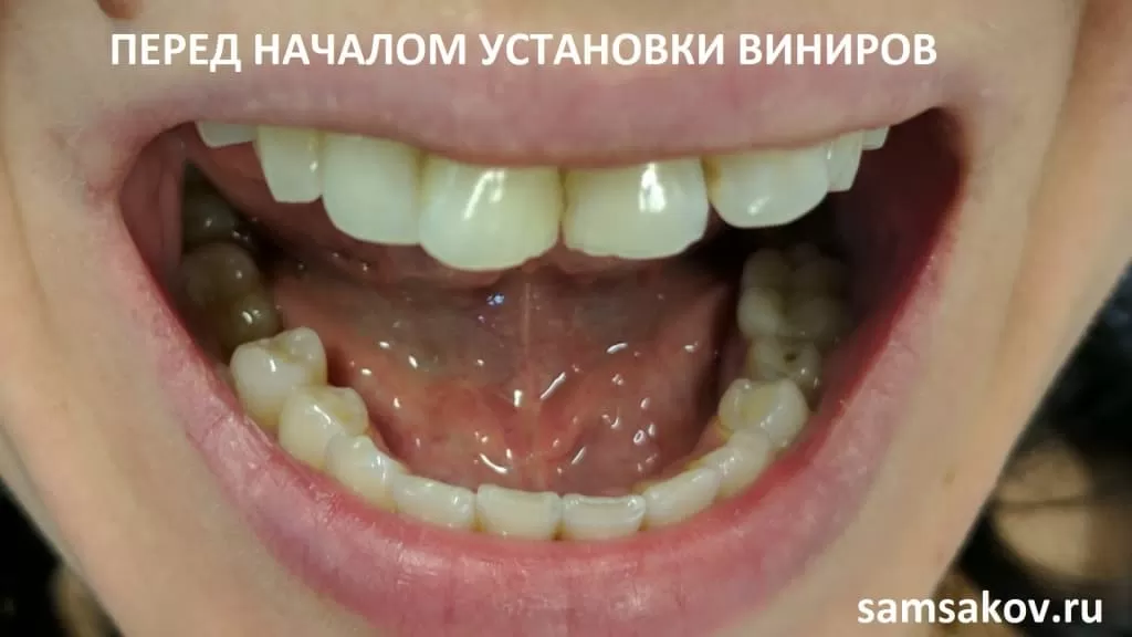 На момент обращения зубы пациентки имели разную высоту и различные угловые отклонения. Лечащий врач - ортопед Сергей Самсаков, клиника Церекон