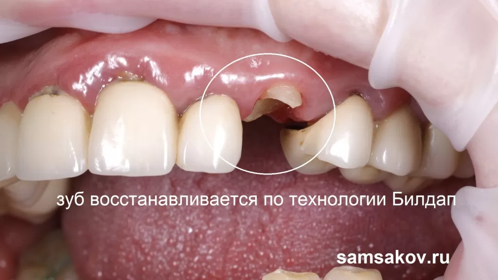 Билд ап применяется для случаев, когда от зуба остался практически один корень:
