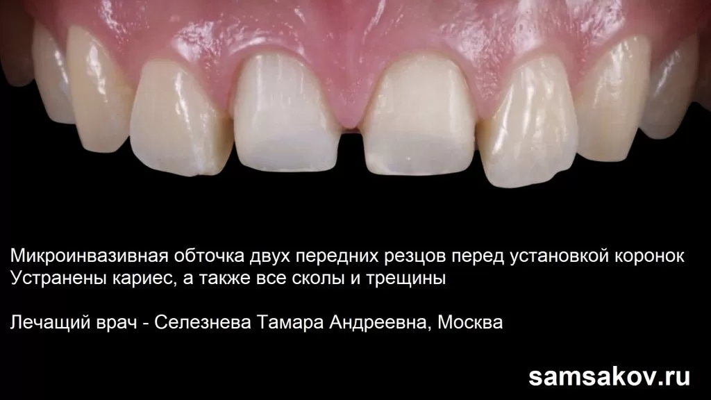 Микроинвазивная обточка передних зубов - эталон эстетической реставрации. 