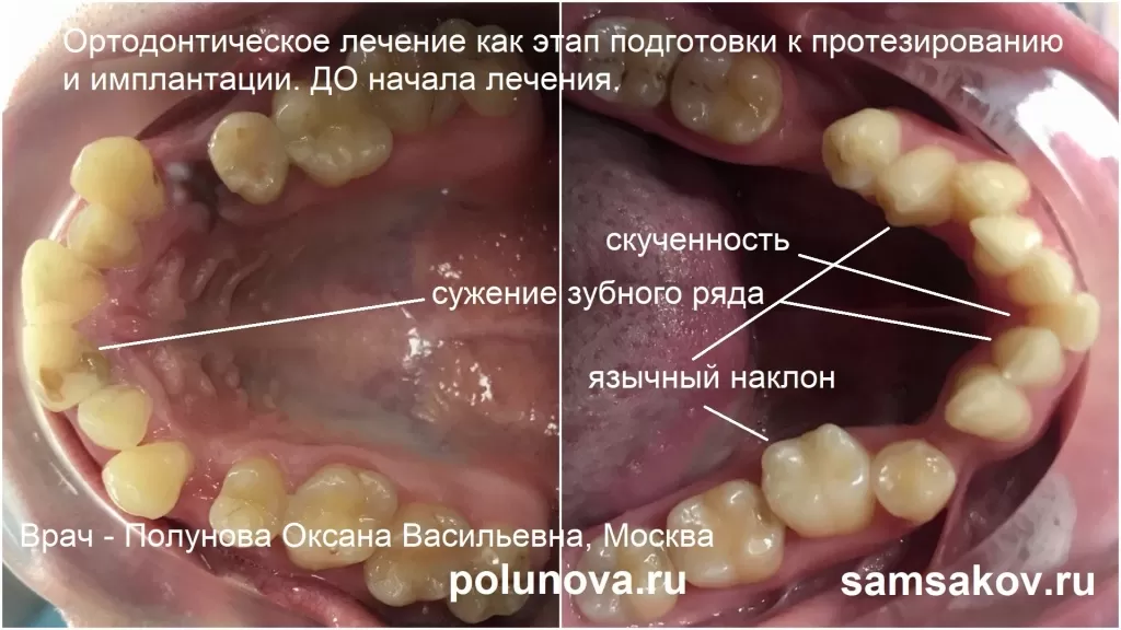 Ортодонтическое лечение как этап подготовки пациента к протезированию и имплантации. Врач - Полунова Оксана Васильевна