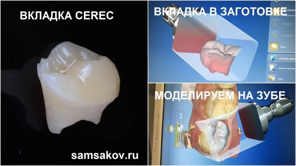примерка в компьютерной модели и изготовление вкладки CEREC -ортопед клиники Церекон Сергей Самсаков