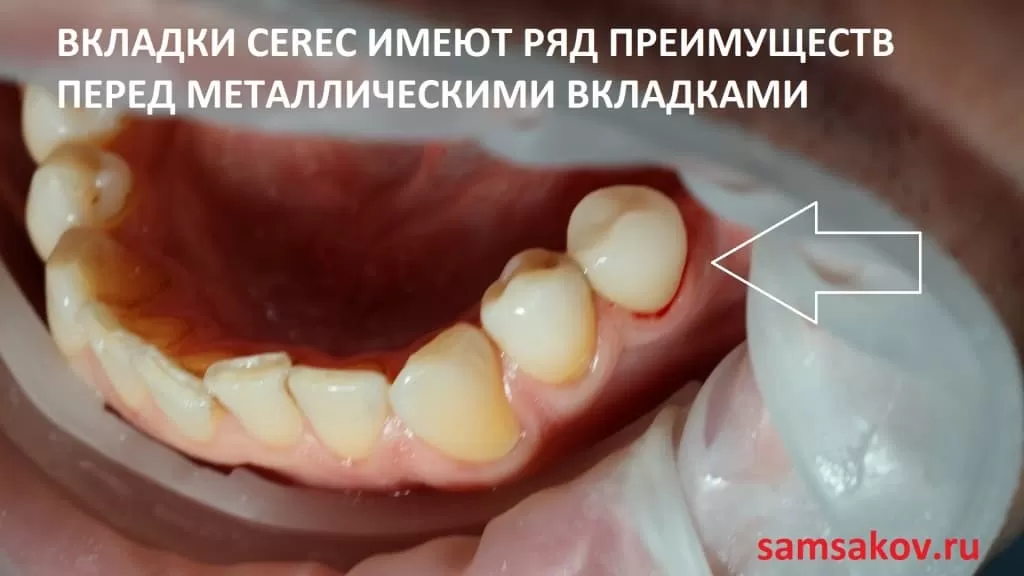 керамическая вкладка на зуб из циркония