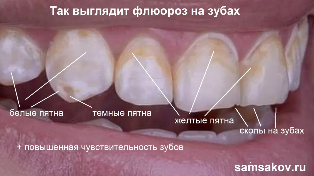 Как выглядят зубы при флюорозе. Пятна на зубах.