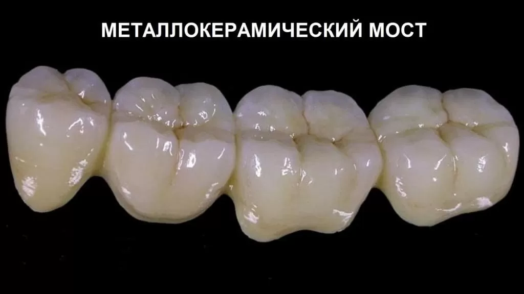 Если в боковой зоне челюсти недостает двух и более зубов, идеальный метод установки коронок – это создание моста на жевательные зубы