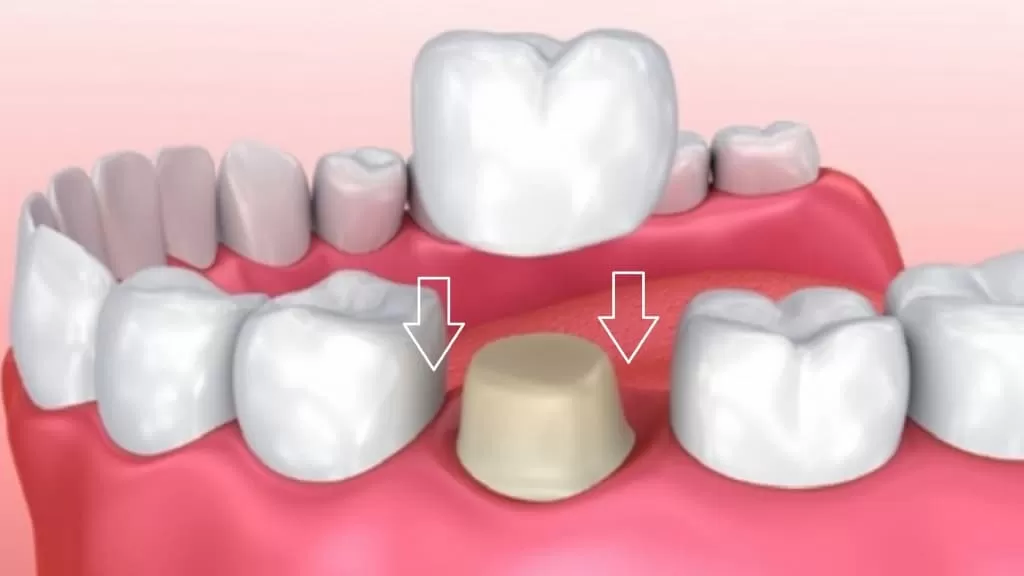 Коронка представляет собой миниатюрную стоматологическую конструкцию в виде колпачка, форма которого аналогична форме заменяемого зуба