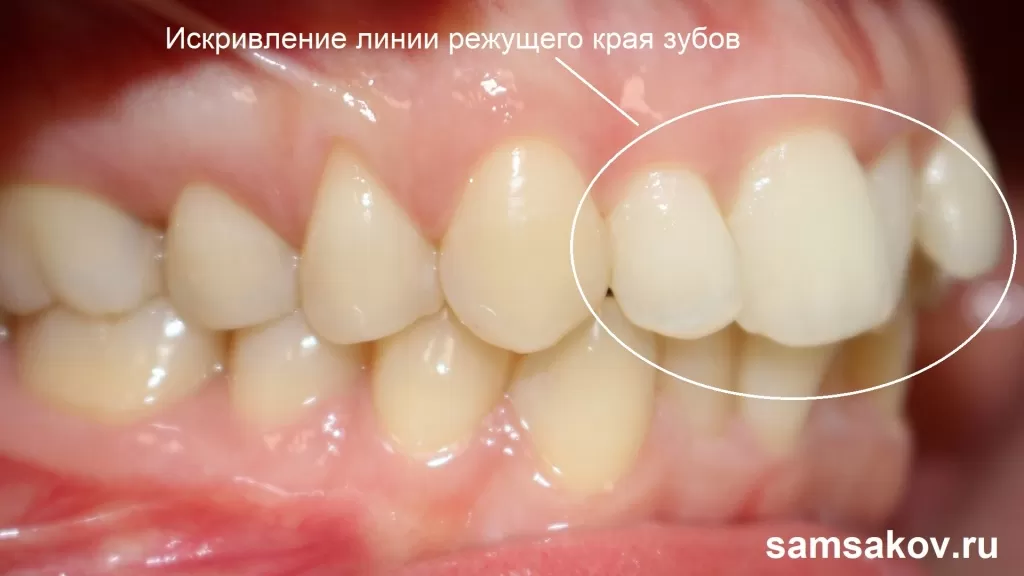 Верхние зубы нависают над нижними
