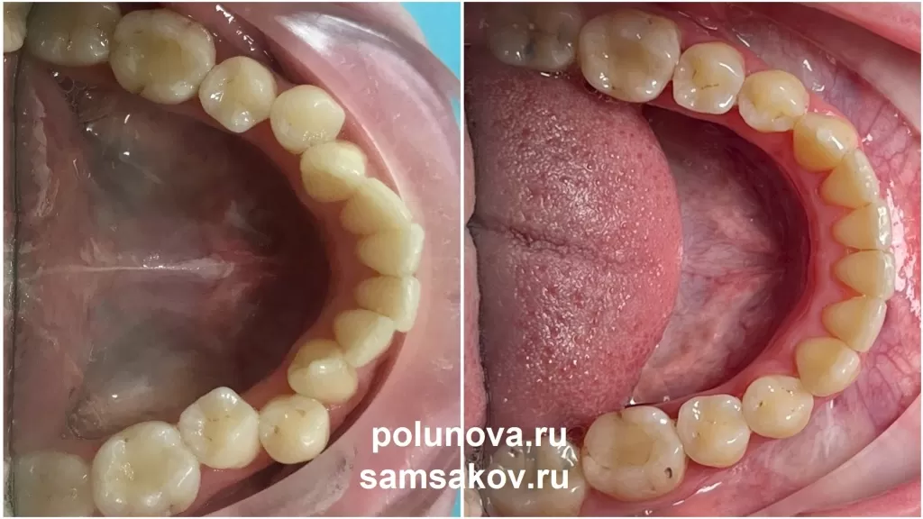 Вид нижних зубов до и после лечения глубокого прикуса на брекетах Damon Clear